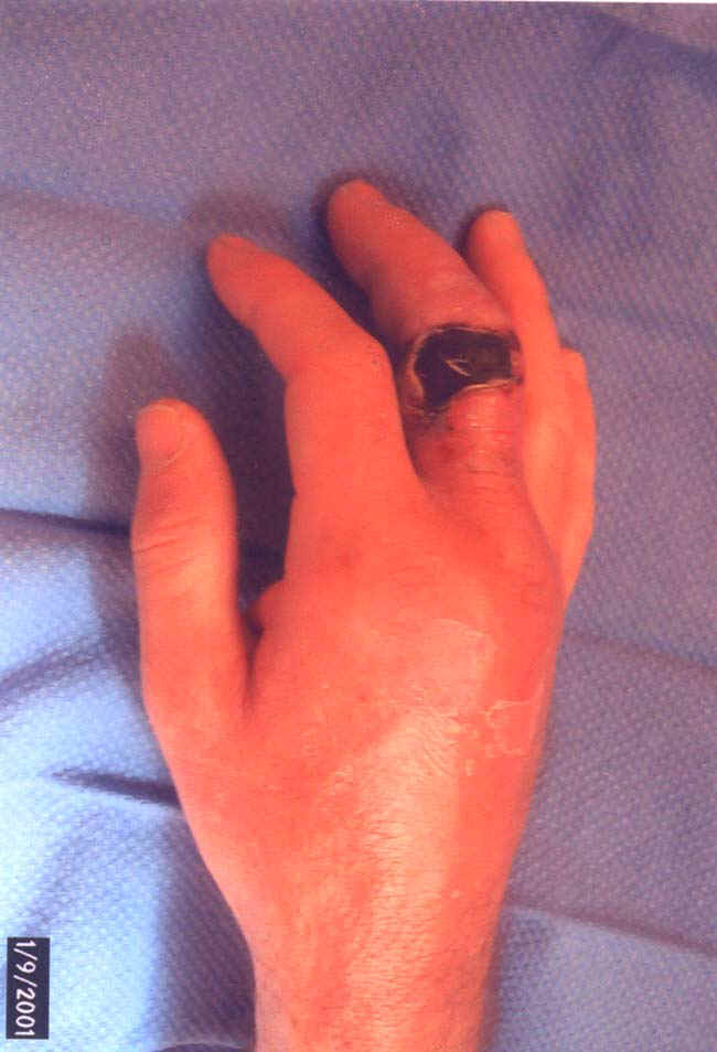 poisonous snake bite